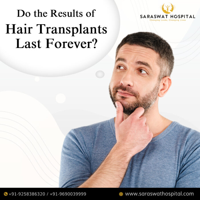 Do Hair Transplant Results Last Forever?