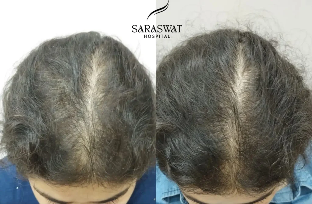 Women Hair Loss Result