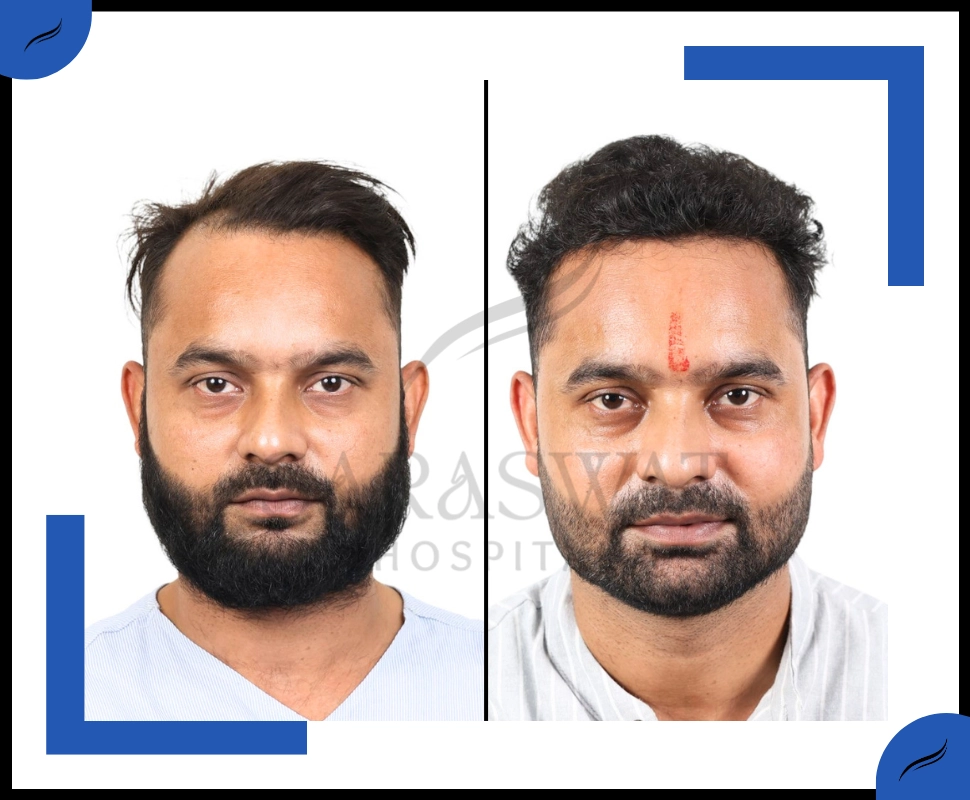 FUE hair transplant result