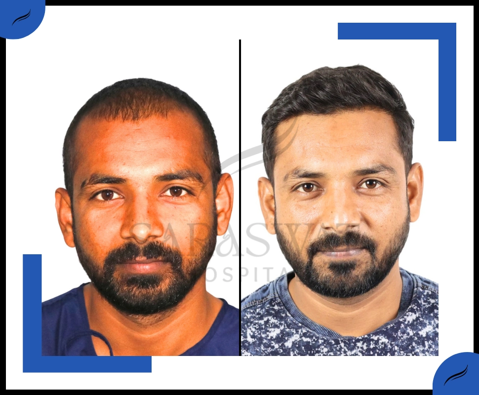 Hair Transplant Result