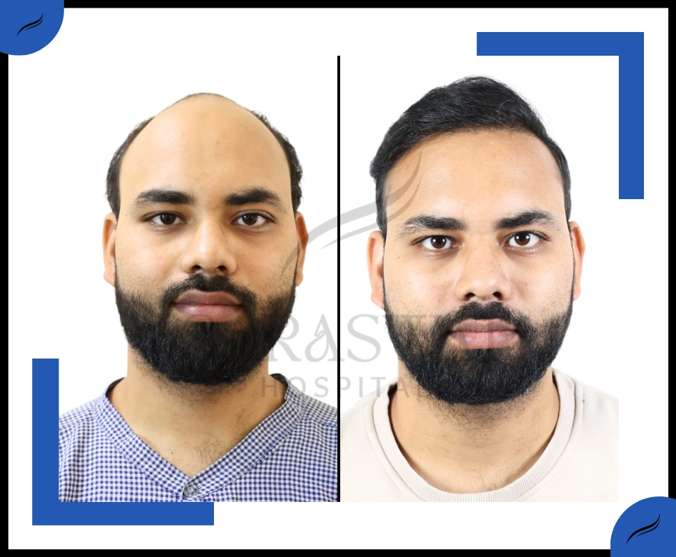 FUE hair transplant result