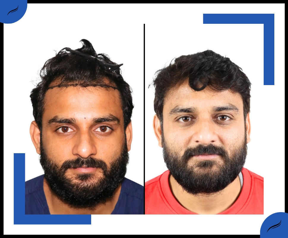 Hair Trasplant Before and After Result