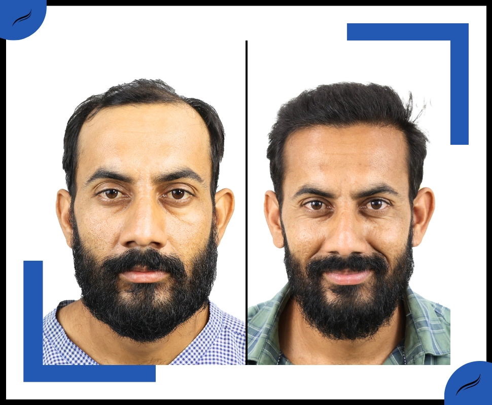 Hair Transplant Before and After