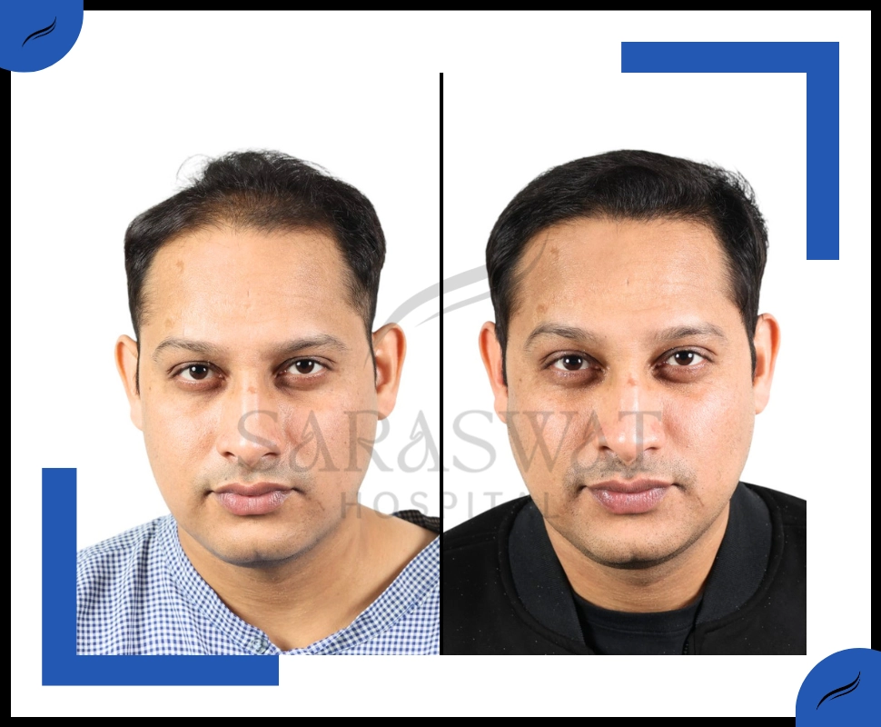 Hair Trasplant Before and After Result