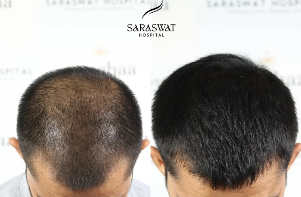 Hair Loss Before and After Result