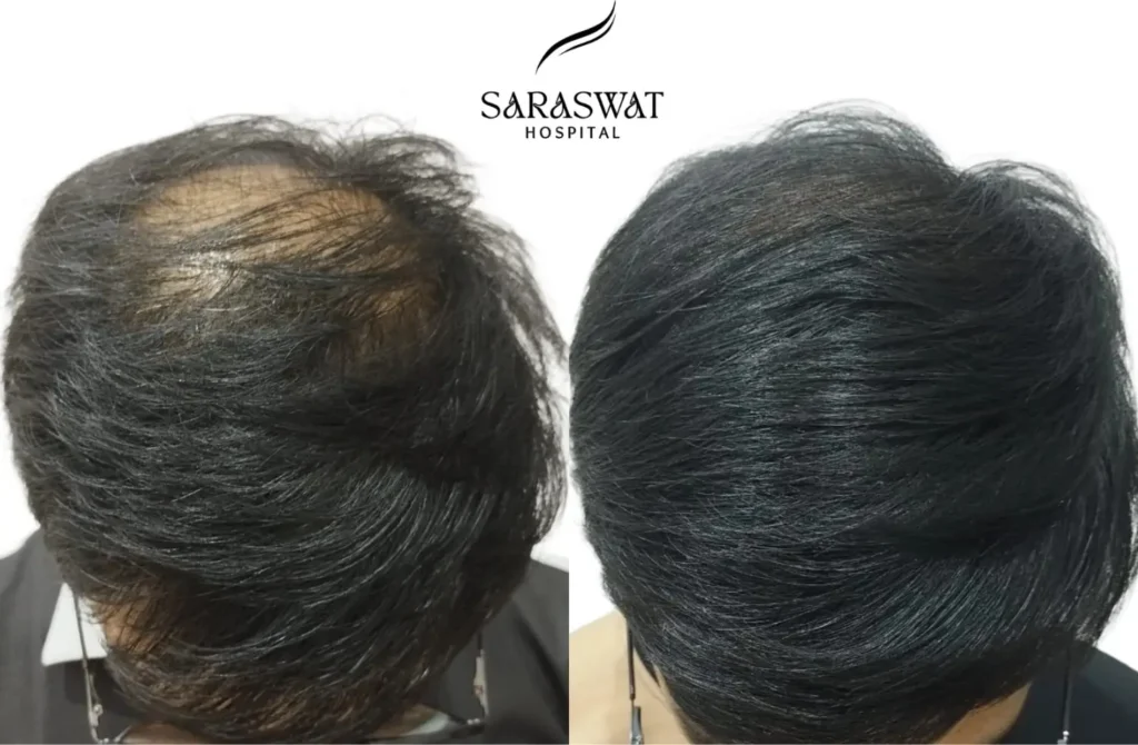 Hair Loss Before and After Result