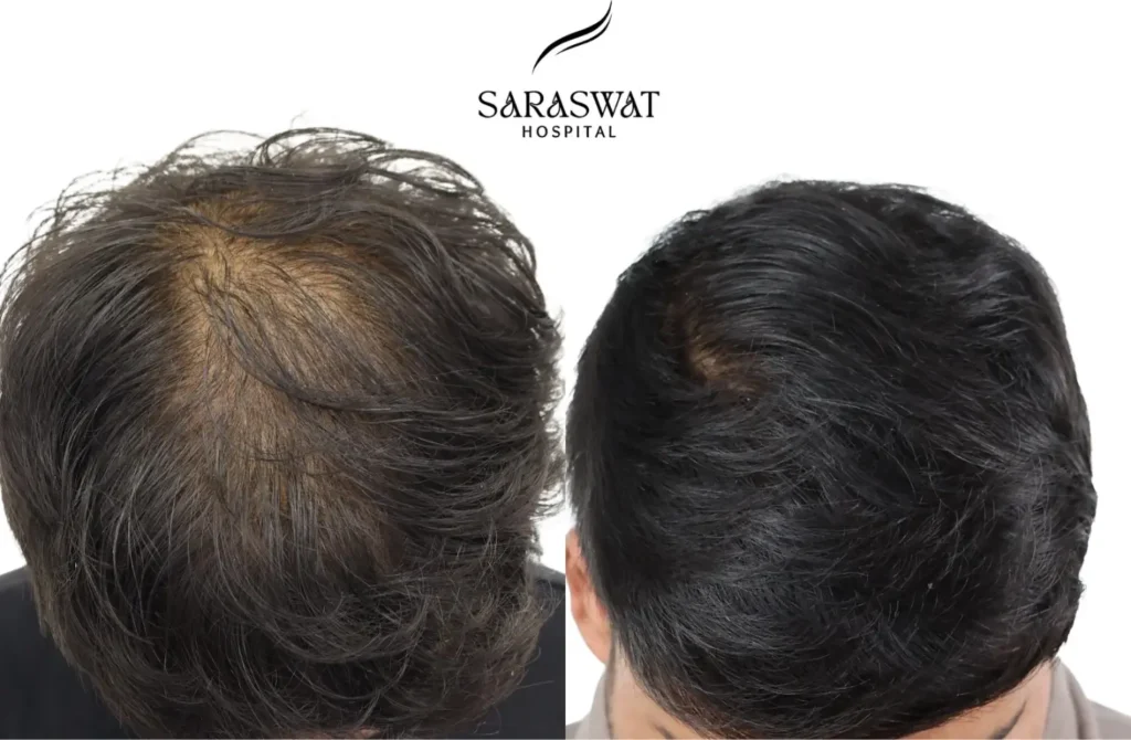 Hair Loss Result