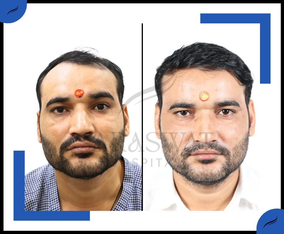 Hair Trasplant Before and After Result