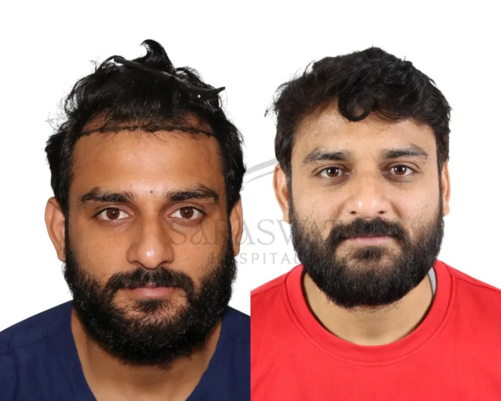 Hair Trasplant Before and After Result