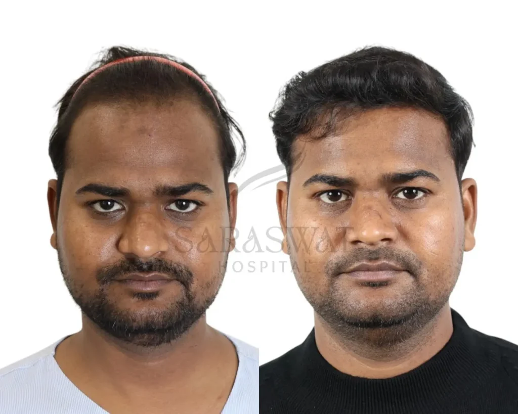 Hair Trasplant Before and After Result