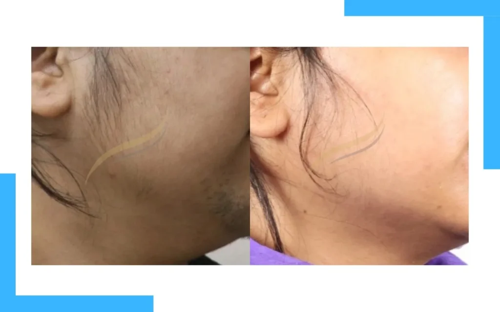 Laser Hair Removal Result