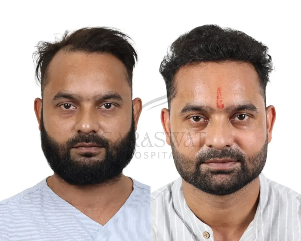 Hair Transplant Result