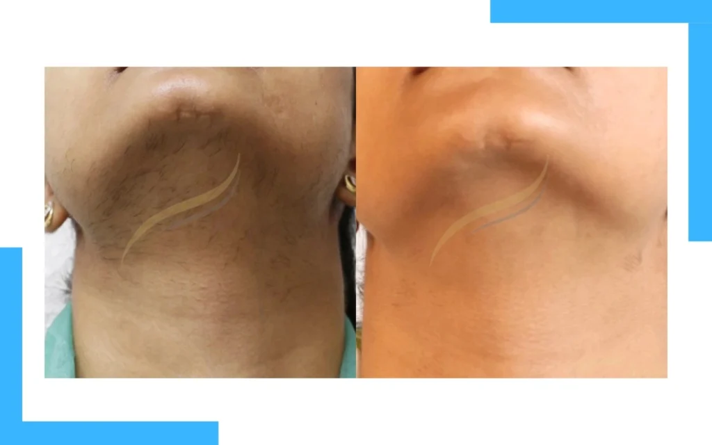 Chin Laser Hair Removal Result