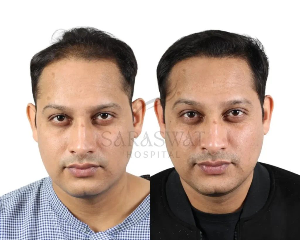 Hair Trasplant Before and After Result