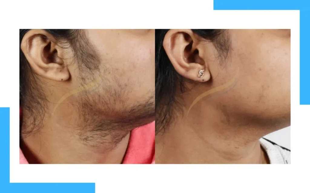 Facial Laser Hair Removal Result
