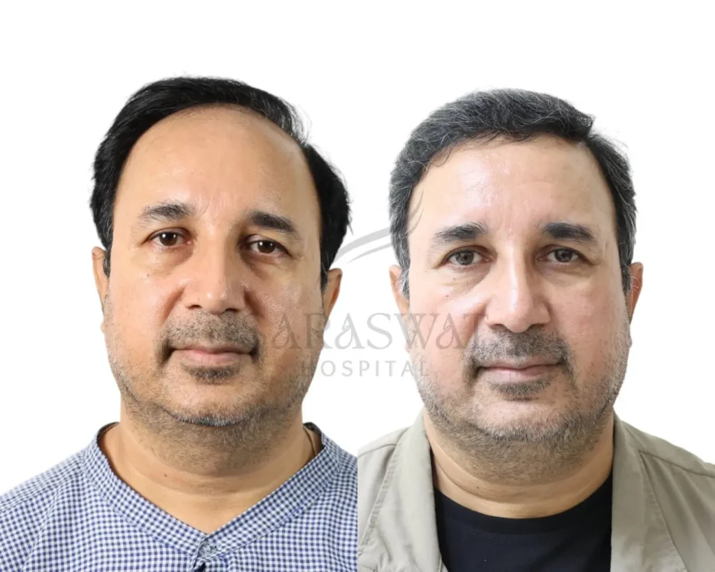 Hair Trasplant Before and After Result