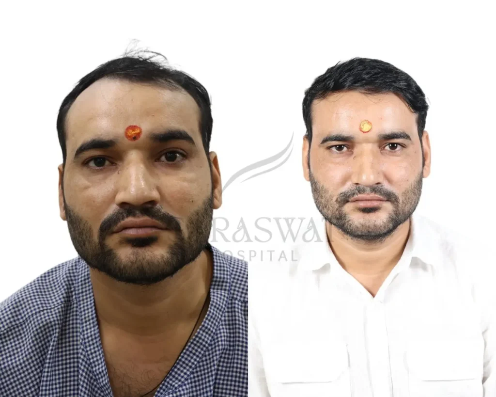 Hair Trasplant Before and After Result