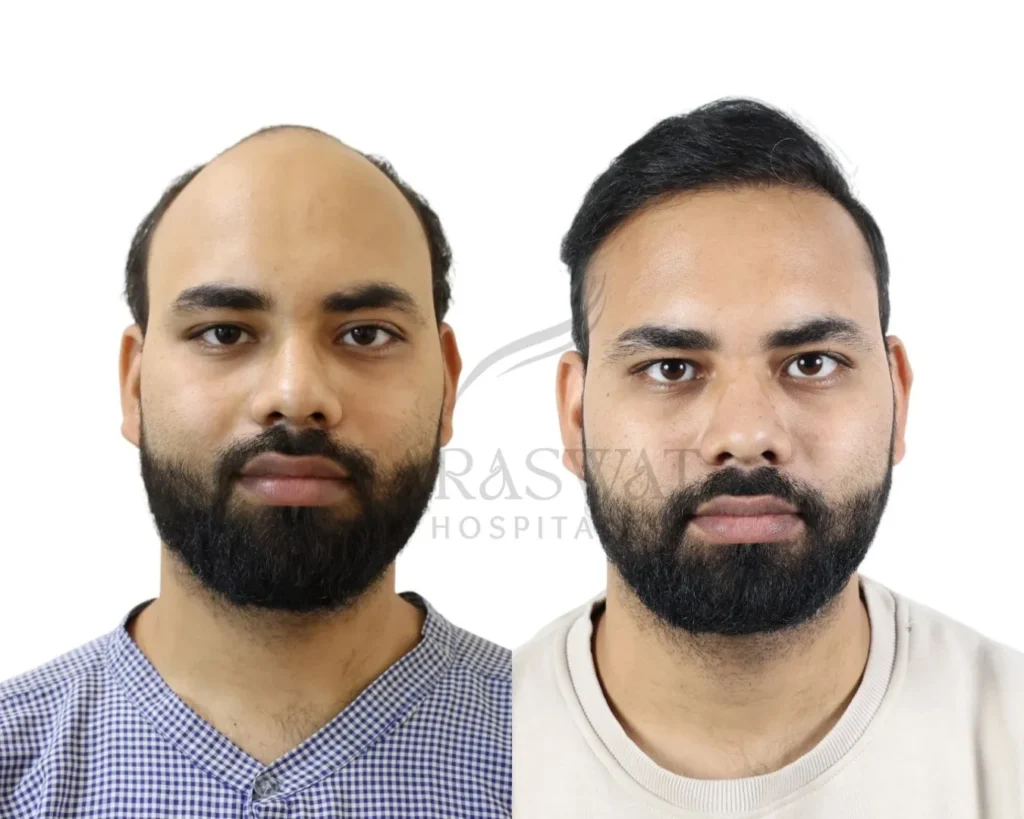 Hair Trasplant Before and After Result