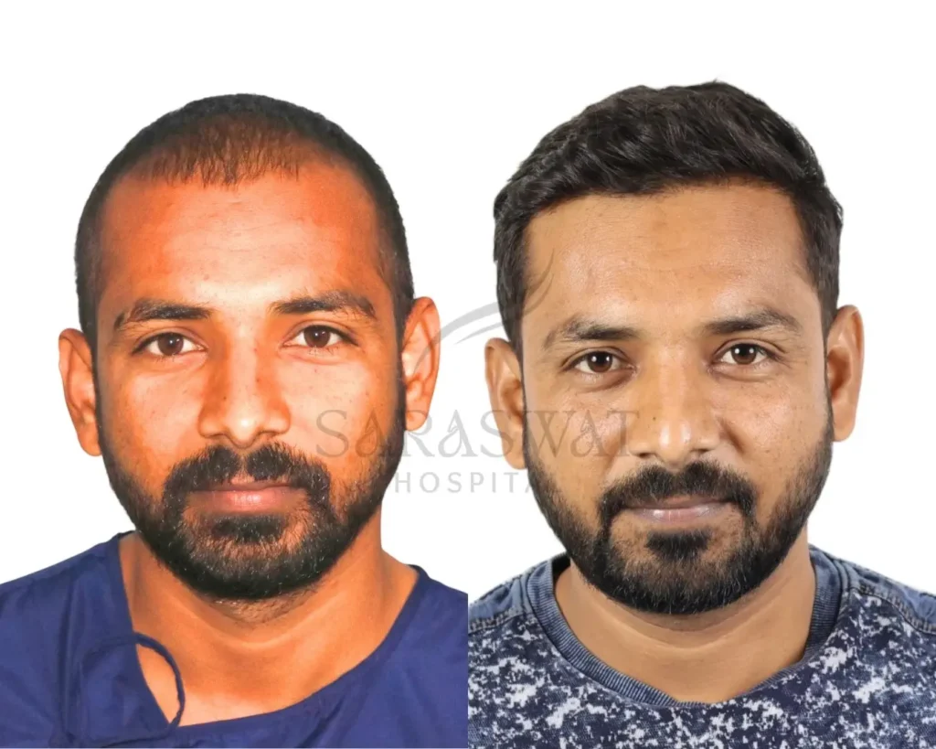 Hair Transplant Result