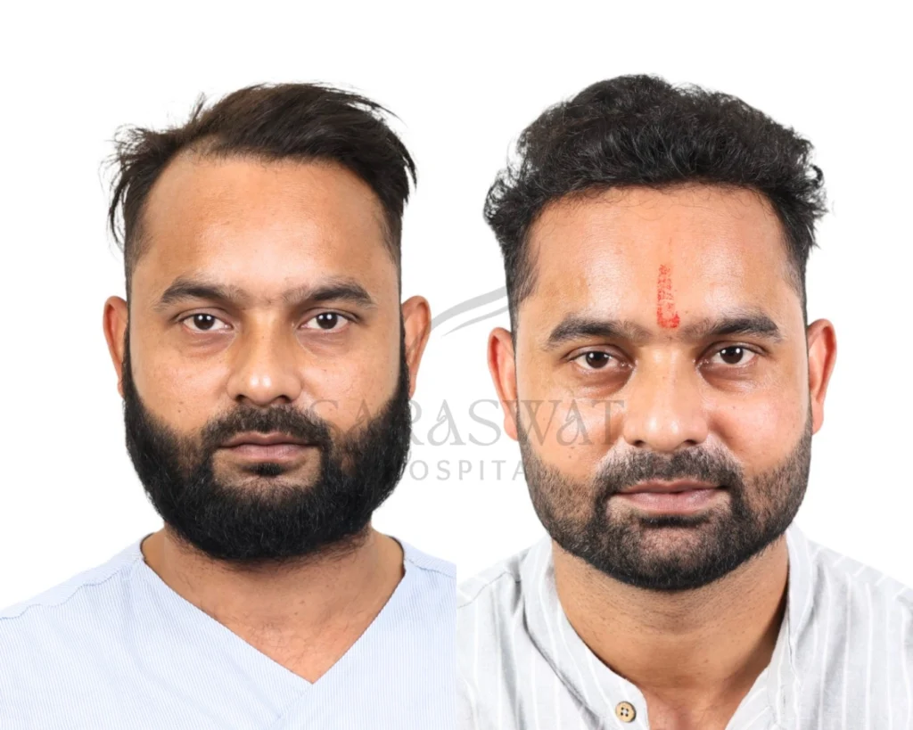 Hair transplant before and after