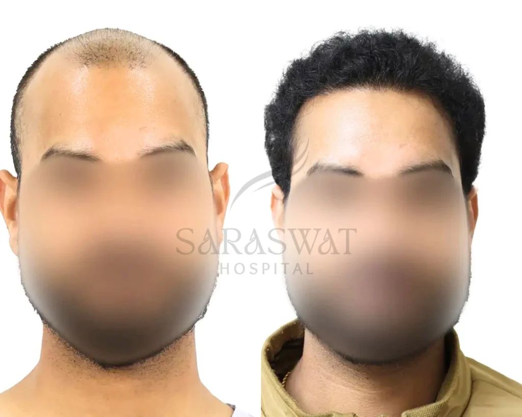 Hair transplant result