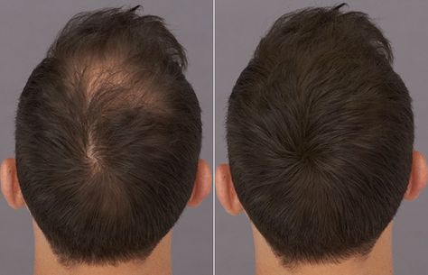 Advantages of FUE Hair Transplant in India