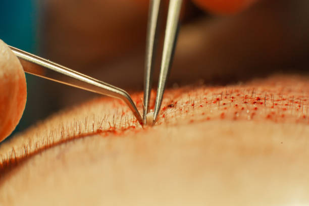 High-Density Hair Transplant (Combined FUE + FUT Hair Transplant in India)