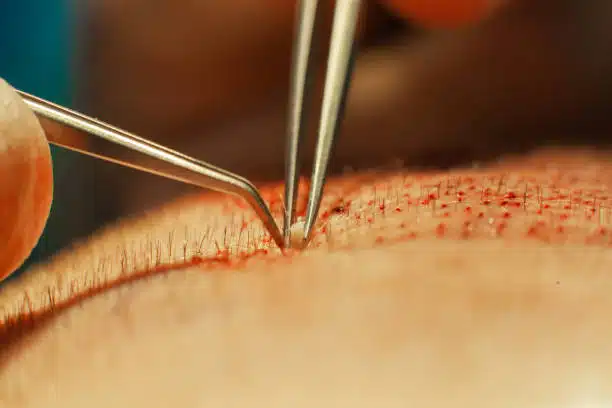 High-Density Hair Transplant (Combined FUE + FUT Hair Transplant in India)