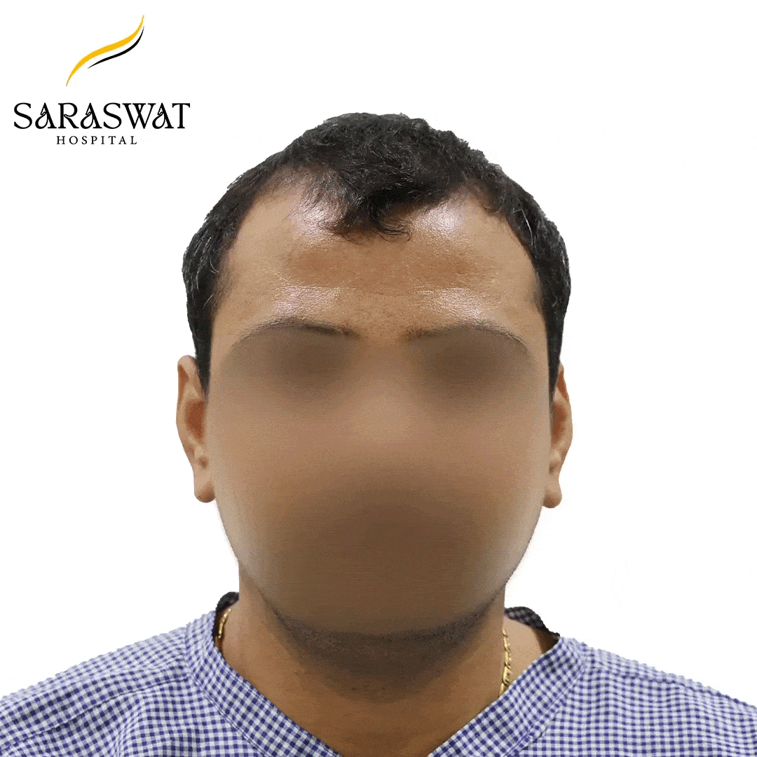 Hair Transplant Before and After Result