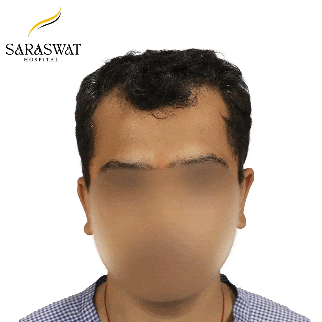 Hair Transplant Before and After Results