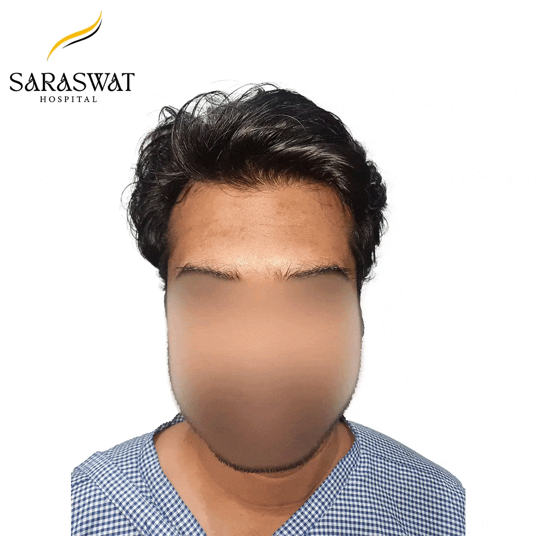 Hair Transplant Result