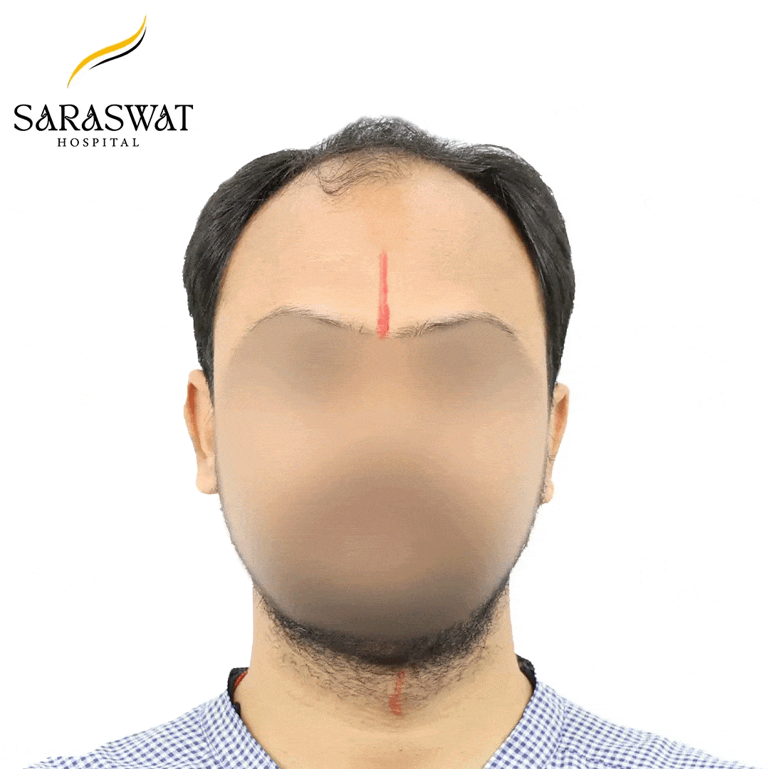 Hair Transplant Before and After