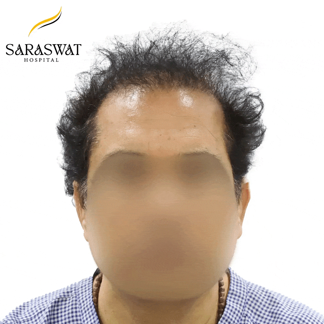 Hair Transplant Before and After