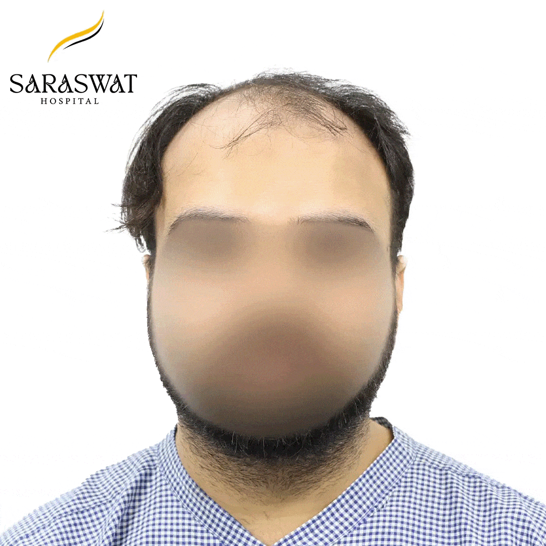 Hair Transplant Before After