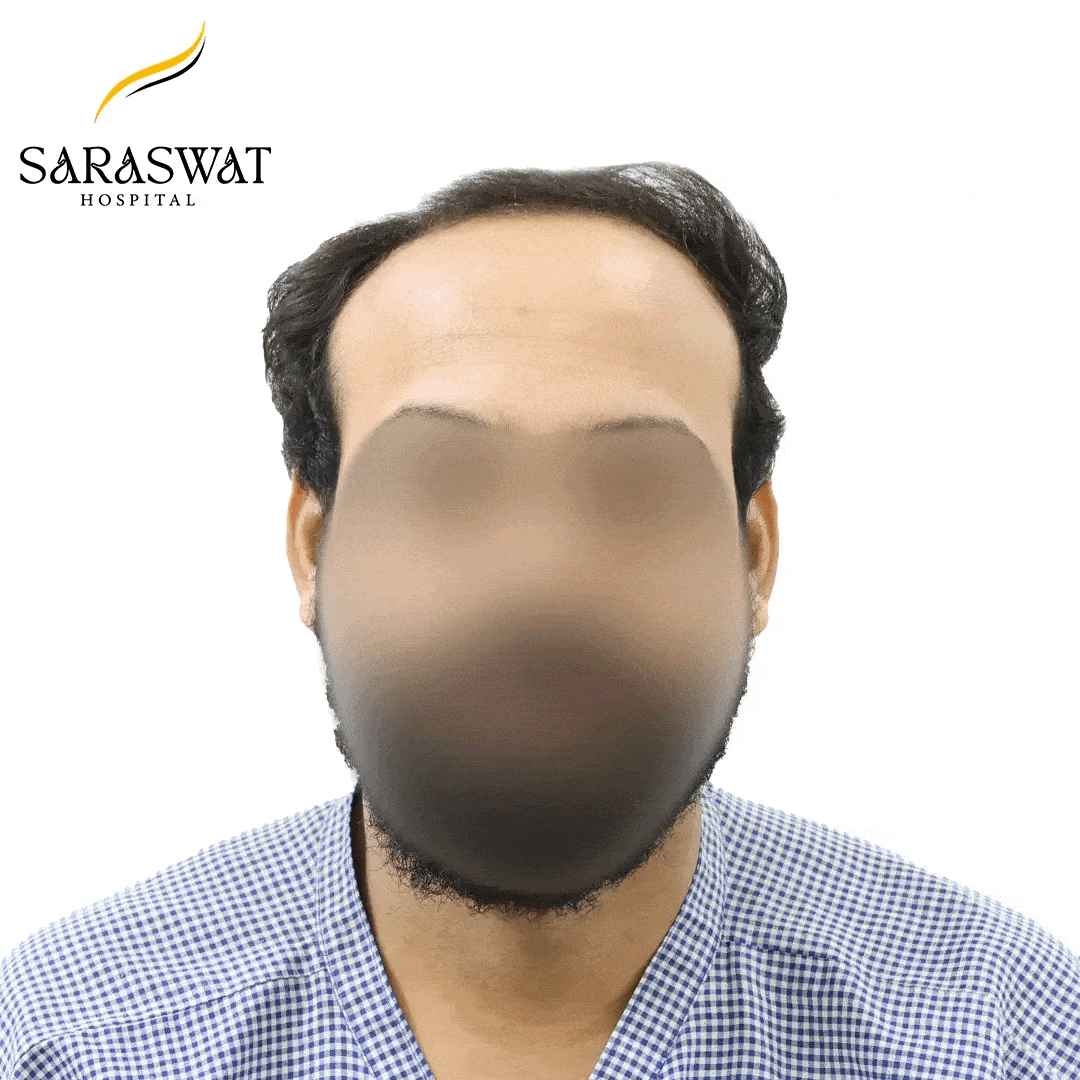 Hair Transplant Before and After Results