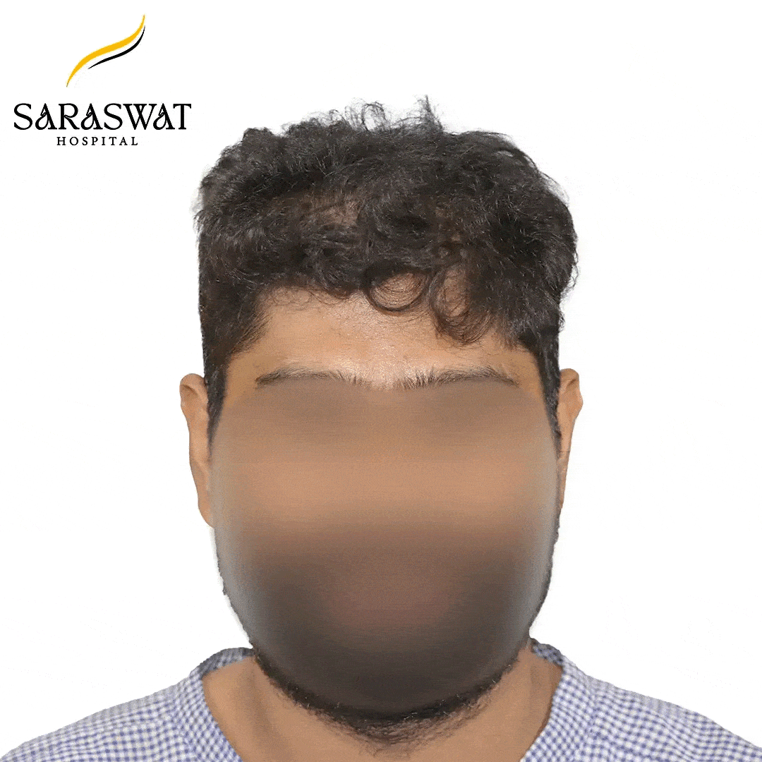 Hair Transplant Before and After Result
