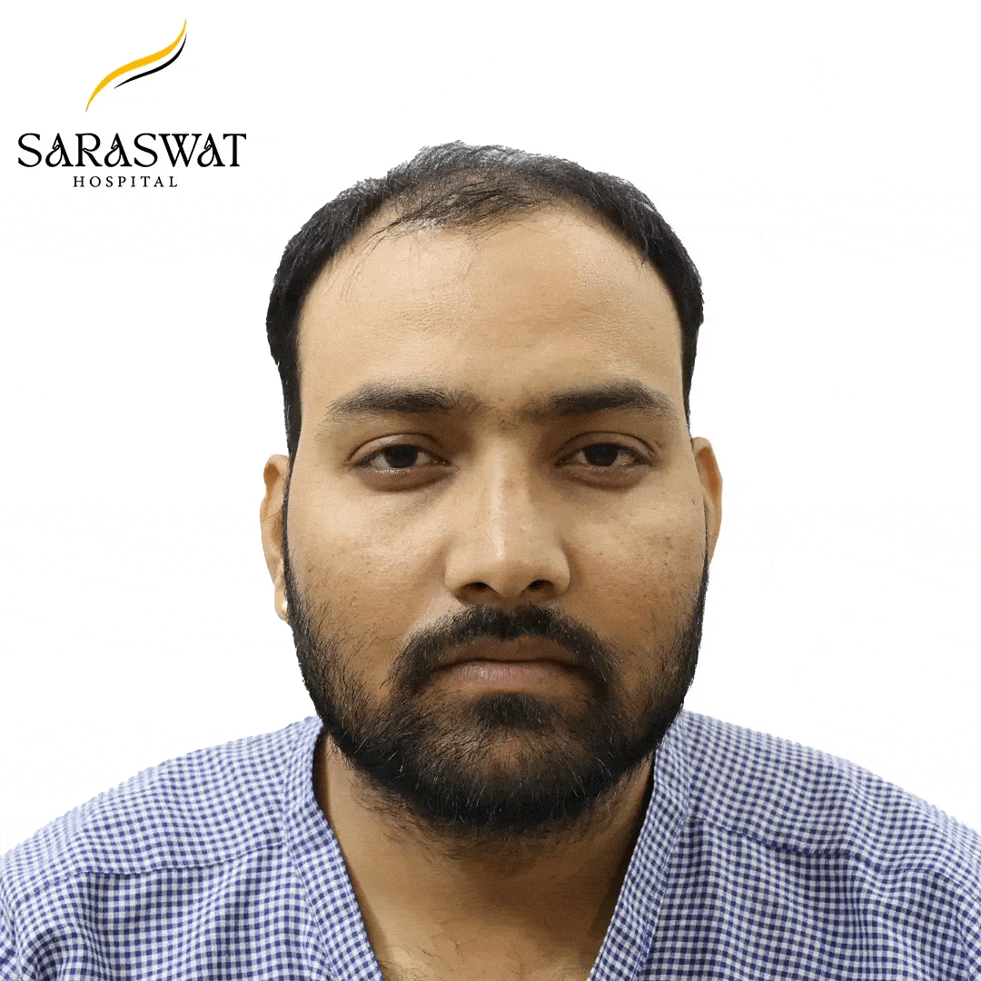 Hair Transplant Before After