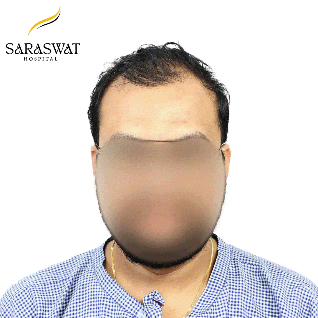 Hair Transplant Before and After Results