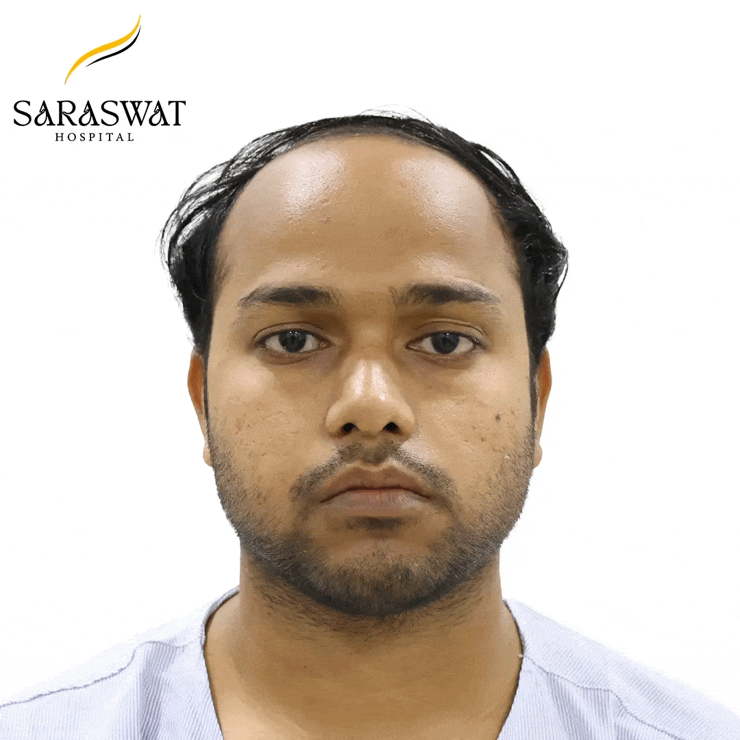 Hair Transplant Before and After Results