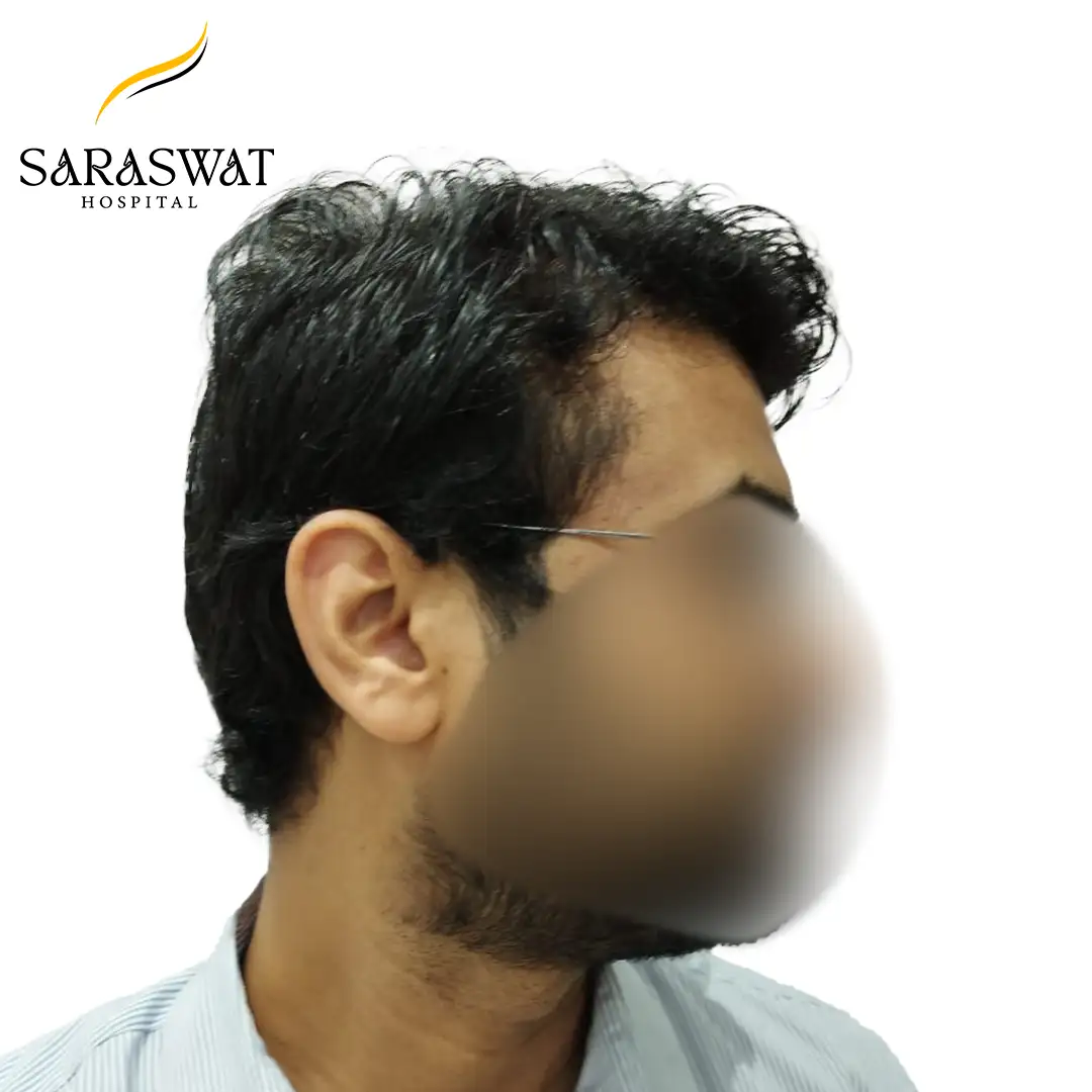 Hair Transplant Result