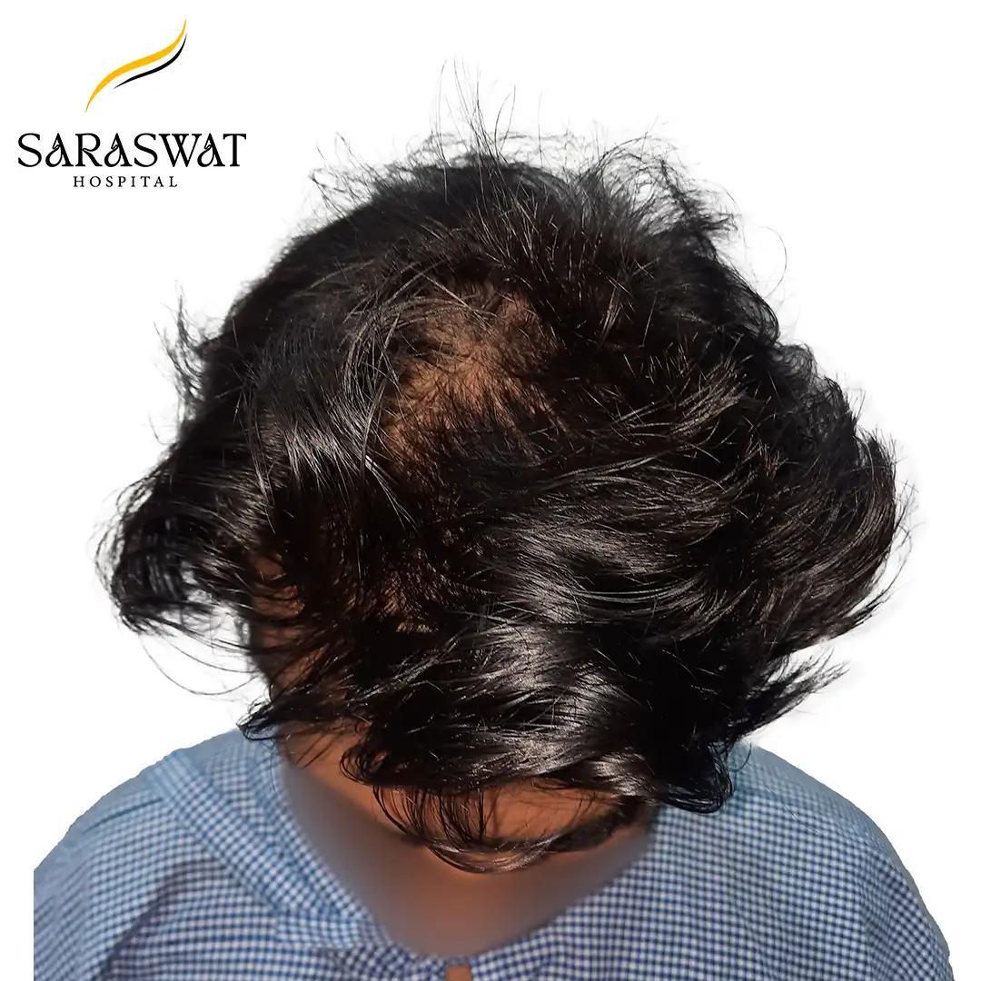 Hair Transplant Before and After Results
