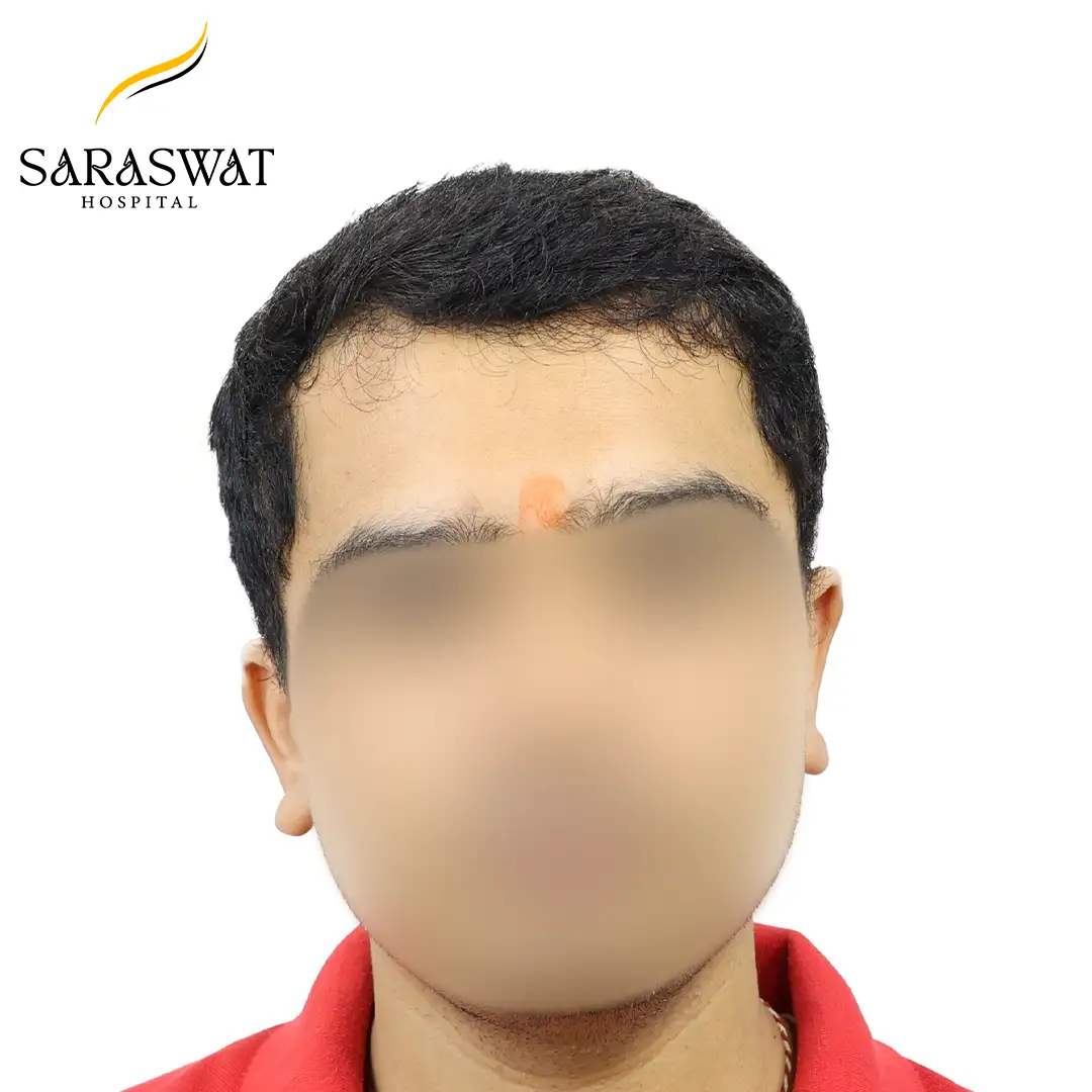 Front FUE Hair Transplant Result After Procedure