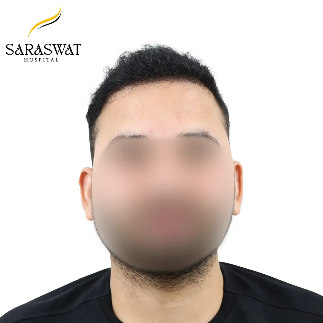 Front FUE Hair Transplant Result After Procedure