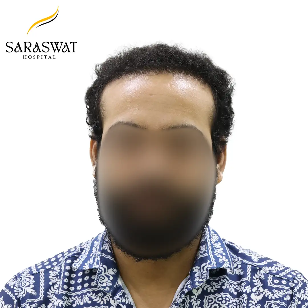 FUE Hair Transplant