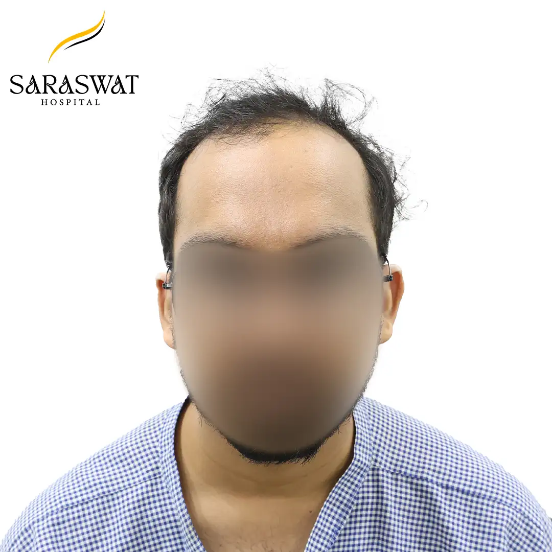 Front FUE Hair Transplant Result Before Procedure