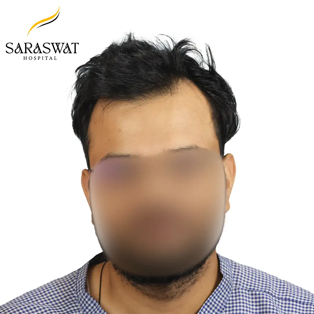 Front FUE Hair Transplant Result Before Procedure