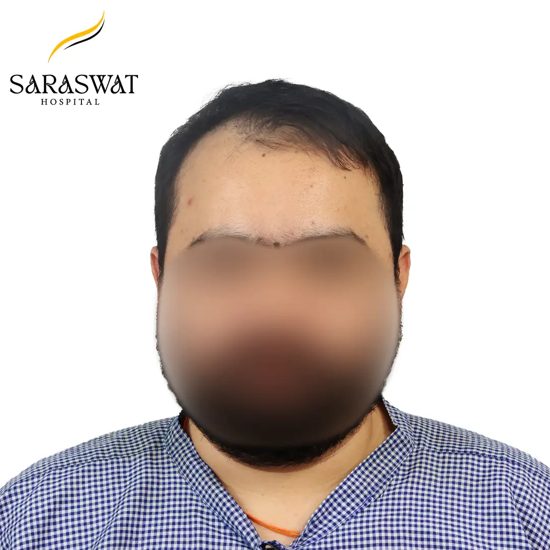 Front FUE Hair Transplant Result Before Procedure