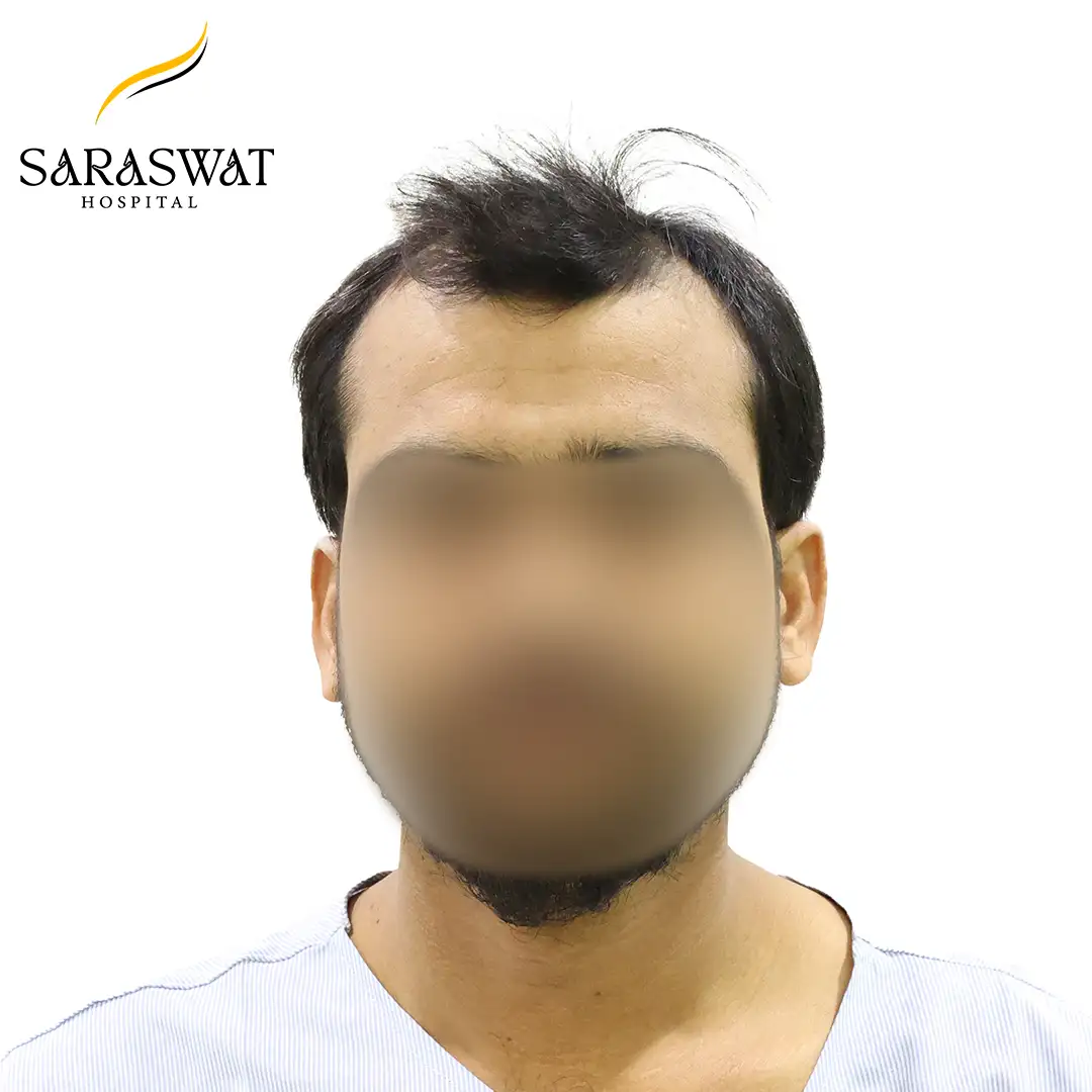 Front FUE Hair Transplant Result Before Procedure