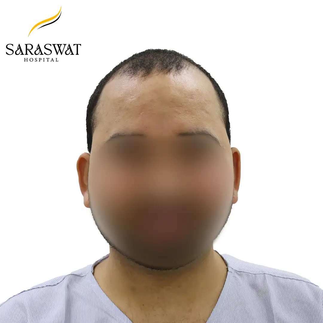 Front FUE Hair Transplant Result Before Procedure