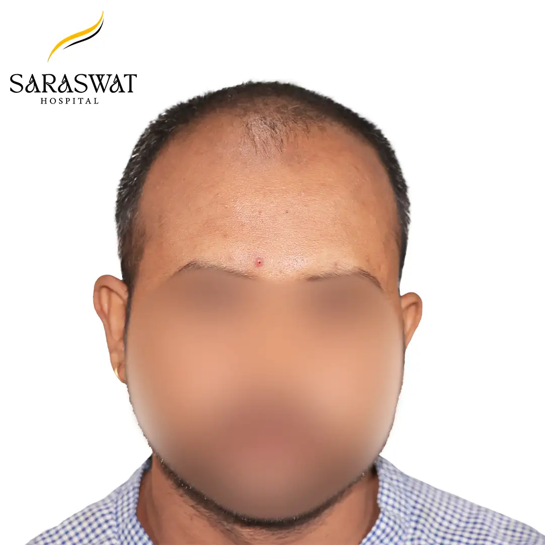 Hair Transplant Before and After Results